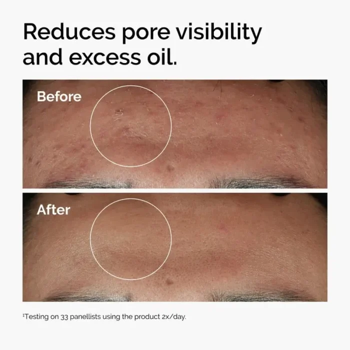 ordinary-niacinamide-zinc-blemish-serum-before-after-pores