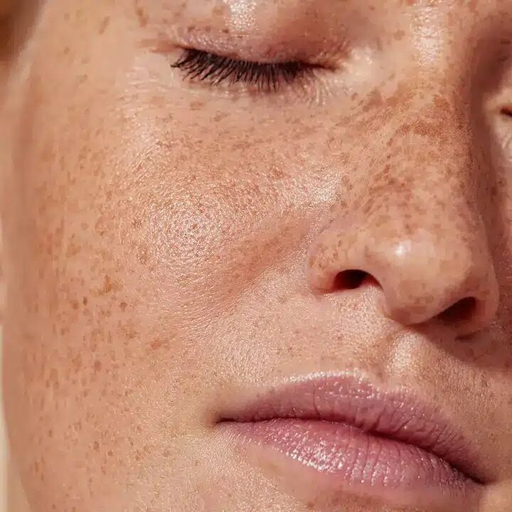 Hyperpigmentation-luxxur
